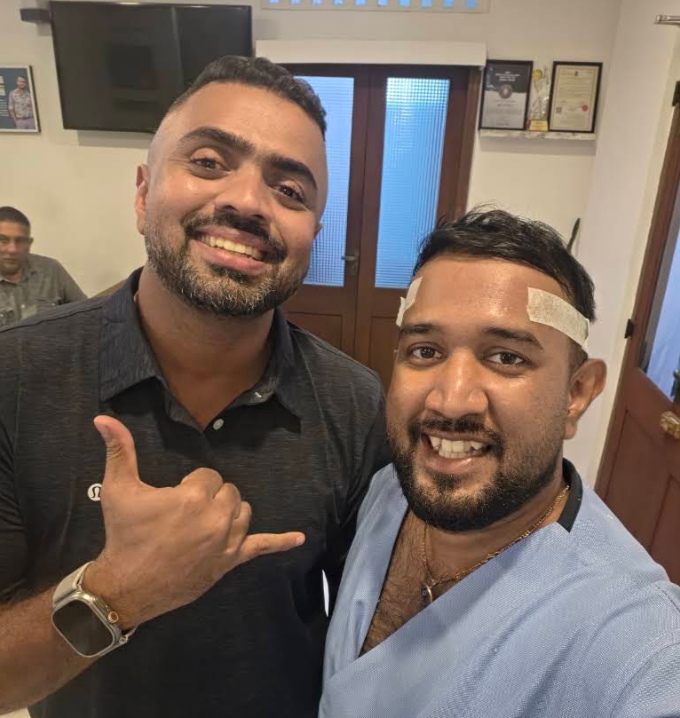 Dilip Kanakarathna DHI hair transplant